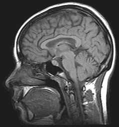 頭部のMRI画像